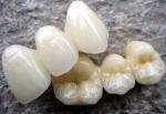 High Biocompatibility PFM Crown Porcelain Fused For Back Teeth Restoration