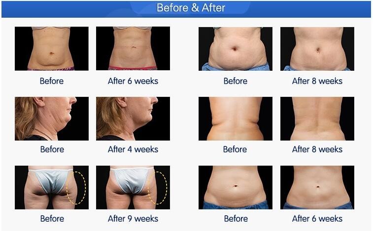 CE / FDA approved 5 treatment handles 10.4 inch screen cool tech fat freezing cryolipolysis