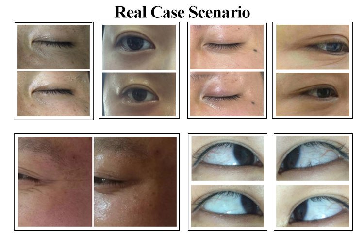 Rf Skin Tightening Eye Dark Circle Removal Beauty Equipment Face Wrinkle Removal