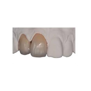 Quality Body Strength Thin Zirconia Crown Durable Natural Realistic Restoration wholesale
