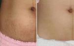 New product ideas 40W medical fractional CO2 laser for Acne removal and scar