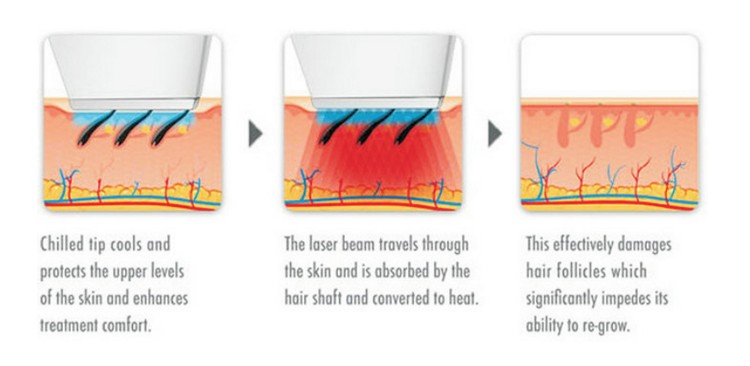 Vertical 3 In 1 Pain Free Laser Hair Removal Machines / Laser Skin Care Machine
