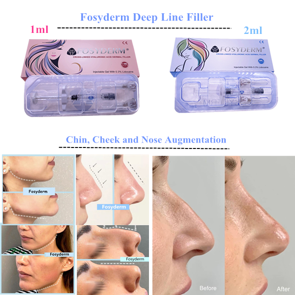 Anti Wrinkle Lips Face Oem Cross Linked Dermal Filler Injection