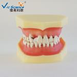 Peridontal Disease Teeth Study Model Human Dental Model Gingival Diseases