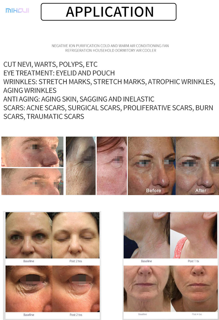 Antibacterial Fractional Plasma Machine Customizable For Spot Removal