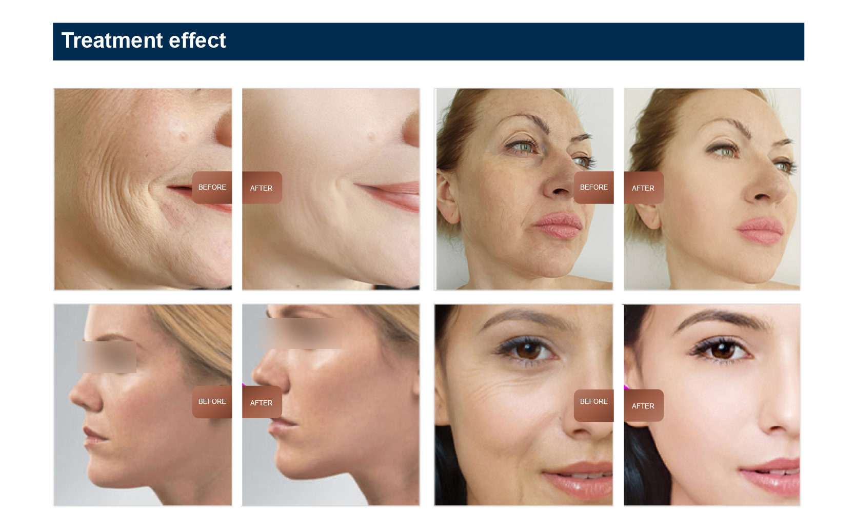 AU Plugs Type Microcurrent Facial Machine for Skin Tightening and Wrinkle Reduction