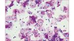 Exfoliative Cell Stain Solution 1x100ml 2x100ml For Medical Diagnosis