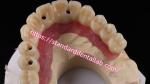 Multi Layer Zirconia Screw Retained Implant Bridge Biocompatible On Metal