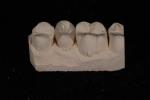Strength Emax Ceramic Veneers Crown With Excellent Stain Resistance / Biocompati