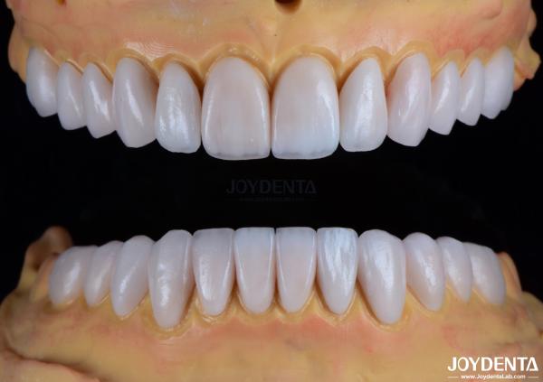 Stain Resistance and Brightness Maintenance Dental Veneers for Chipped Teeth