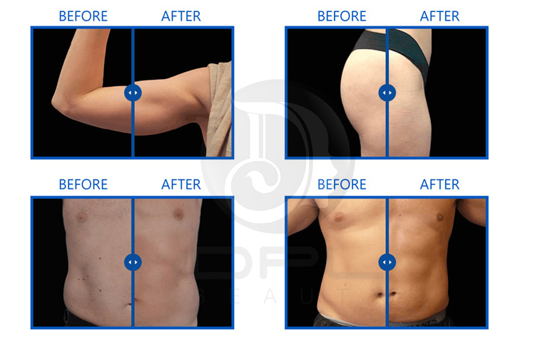 Portable EMS Sculpting Machine Professional Body Slimming Muscle Shaping