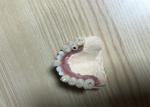 Accurate Biocompatibility Dental Implant Attachments Tooth Implant Crown