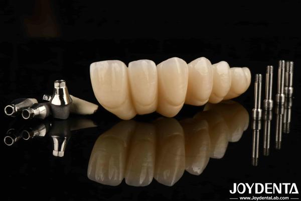 Experience Ultimate Esthetics With Aesthetically Pleasing Dental Implant Crown