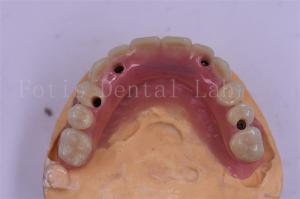Quality Dental Implant Titanium Tooth Crown Precision Fit Custom Design wholesale