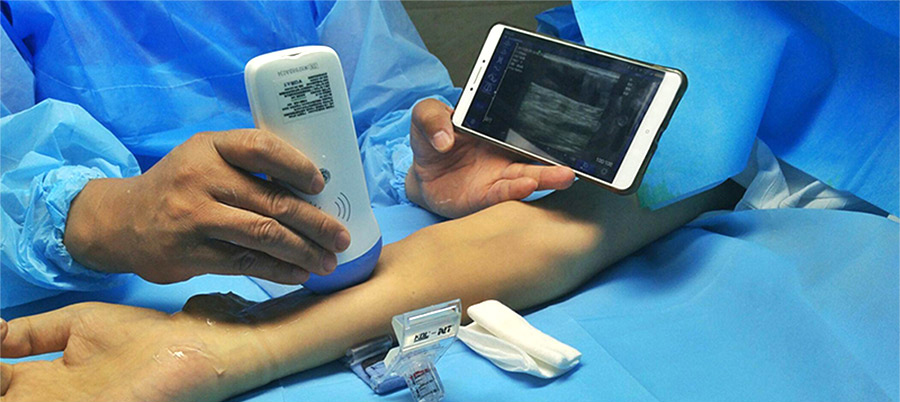 Sonostar Portable Wireless BW Linear PICC Ultrasound Probe For Biopsy Guide