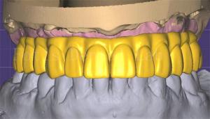 Quality Professional 3shape Crown Design Excellent Performance And Durability wholesale