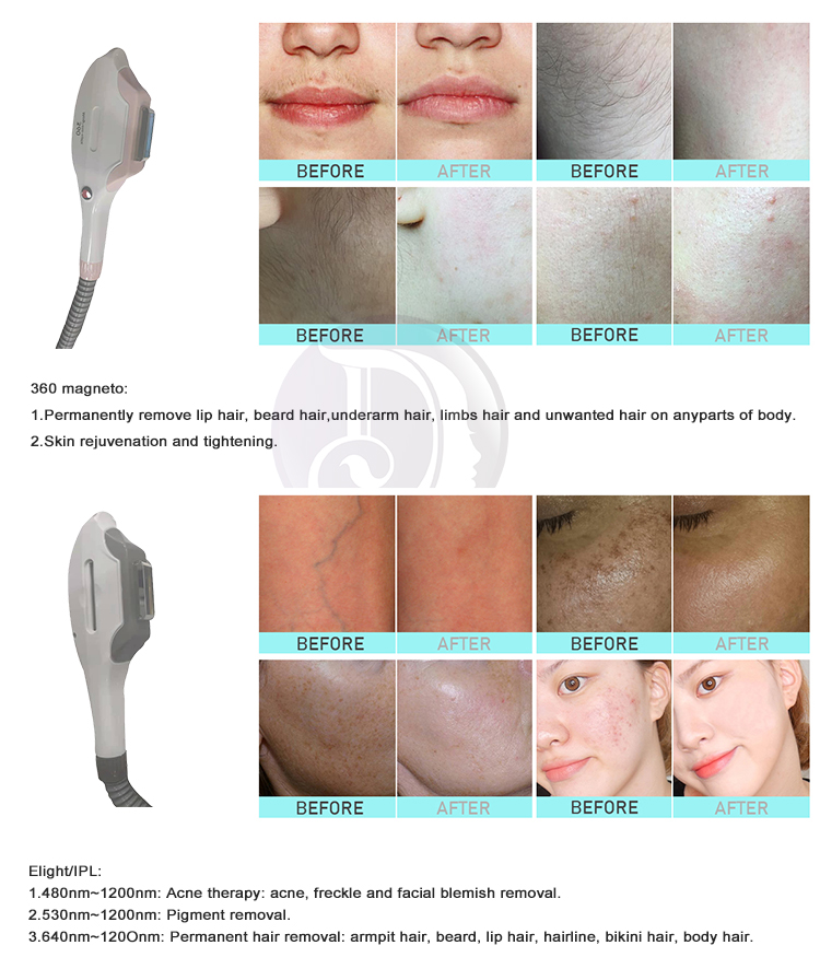 DPL Laser Picosecond 4 IN 1 Dioda Hair Removal And Tatoo Removal Machine RF Face Lift 808 diode pico laser hair removal machine