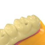 Dental Bridge Photosensitive Resin Lightweight Temporary Crown Resin