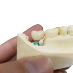 Redefining Aesthetics Our Natura Looking Dental Implant Crowns