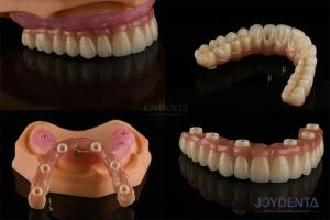 Quality Dental Multiple Teeth Replacement Implants Rough Surface Prosthetic Components wholesale