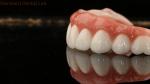 High Quality Dental zirconia crown and All On Four Six Implant Full Arch / China