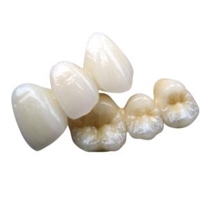 Quality PFM Co Cr 3014652903 Ceramic Dental Bridge Custom Colour Stability wholesale