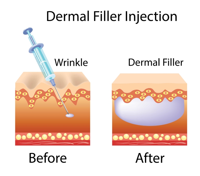 Injectable Hyaluronic Acid JUR KISS Filler For Lips Red Lip Augmentation Injection