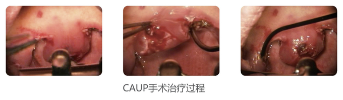 Low Temperature RF Plasma System Cutting Perforation Ablation Cryosurgery Unit