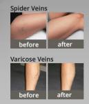 2016 new 980 nm laser spider veins removal Blood Vessels Removal