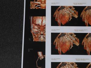 Quality 240gsm 180 Micron Medical Inkjet Film 3D CT Chest Film Environmental Friendly wholesale
