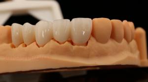 Quality High Aesthetic Anterior Teeth Full Contour Zirconia Crown with Customized Vita Shade Dental Lab wholesale