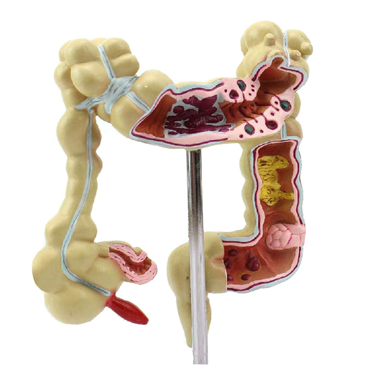 Medical Teaching Pathology Colon Human Anatomy Model 22.5cm On Science