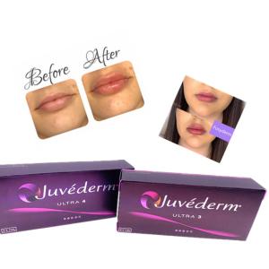Quality Hyaluronic Acid Dermal Gel Injection Juvederm Lip Filler Ce Anti Aging 2ml wholesale