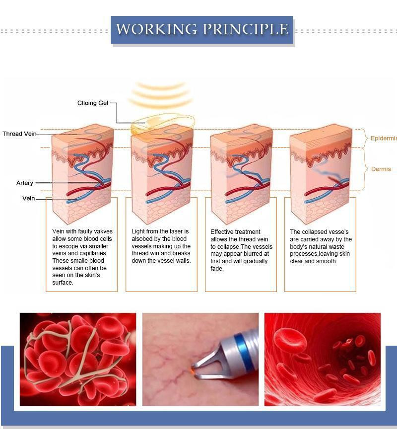 Professional 30W Laser Beauty Machine 980nm Diode Laser Spider Vascular Vein Removal