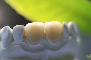 Quality All Ceramic EMAX Porcelain Crown wholesale