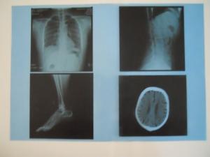 Quality KND-A Low Fog Medical Dry Imaging Film For X Ray Examination On AGFA 5300 / 5302 / 5500 wholesale