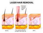 Spa Salon 20HZ 808 Diode Laser Hair Removal Machine