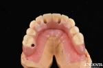 Fast Drying 5 Minutes Acrylic Teeth Finish For Dental Tooth Restoration