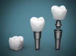 Duable Dental Implant Screw Set Titanium Medical Screw