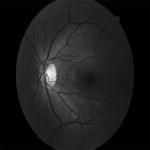 4mm Non Mydriatic Retinal Camera FFA Cataract Disease Imaging