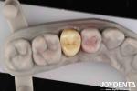Fracture Toughness 9 MPa·m1/2 High Aesthetics High Resistance To Wear Full