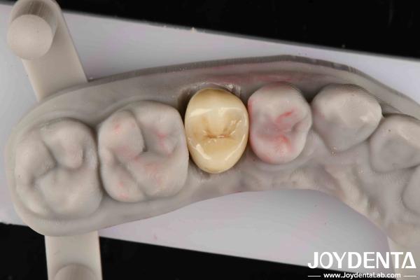 Fracture Toughness 9 MPa·m1/2 High Aesthetics High Resistance To Wear Full