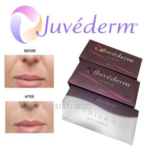 Quality Juvederm Ultra 3 Lidocaine Hyaluronic Acid Lip Filler Injection wholesale
