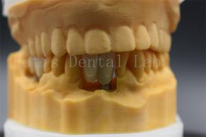 Quality Custom Made Dental Implant Crown Precision Fit For Missing Teeth wholesale