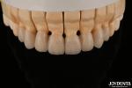 High Translucency Layered Zirconia Crowns Bridges Dental Restorations lifelike