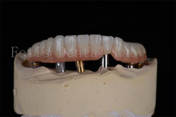 Affordable Natural Looking 4 Or 6 Implants Full Arch Success Rate Minimally
