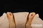 Joydental dental lab Ball Attachment