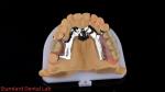 CorCr Metal Partial Denture High Light Beryllium Free Ivoclar Scheftner