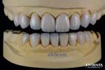 High Biocompatibility Feldspathic Ceramic Veneer Glossy For Dental Restorations