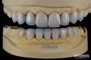 Quality Advanced Ceramic Porcelain Veneers Biocompatible Shade Matched for a Natural Smile wholesale